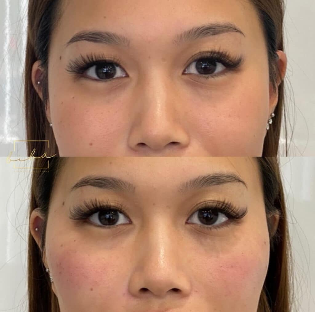 image shows dermal fillers being used for facial harmony, provided at a skin clinic parramatta
