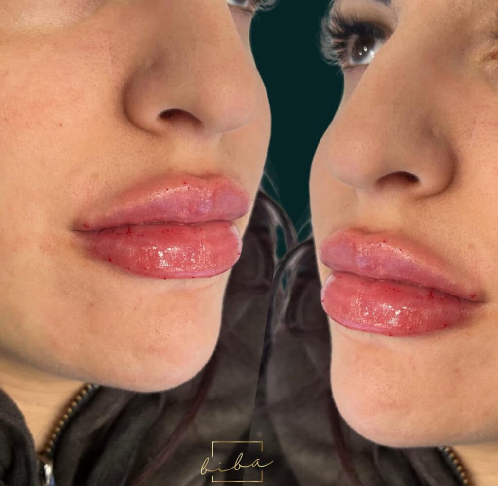 this shows lip injections or lip fillers that were crafted at a cosmetic clinic parramatta