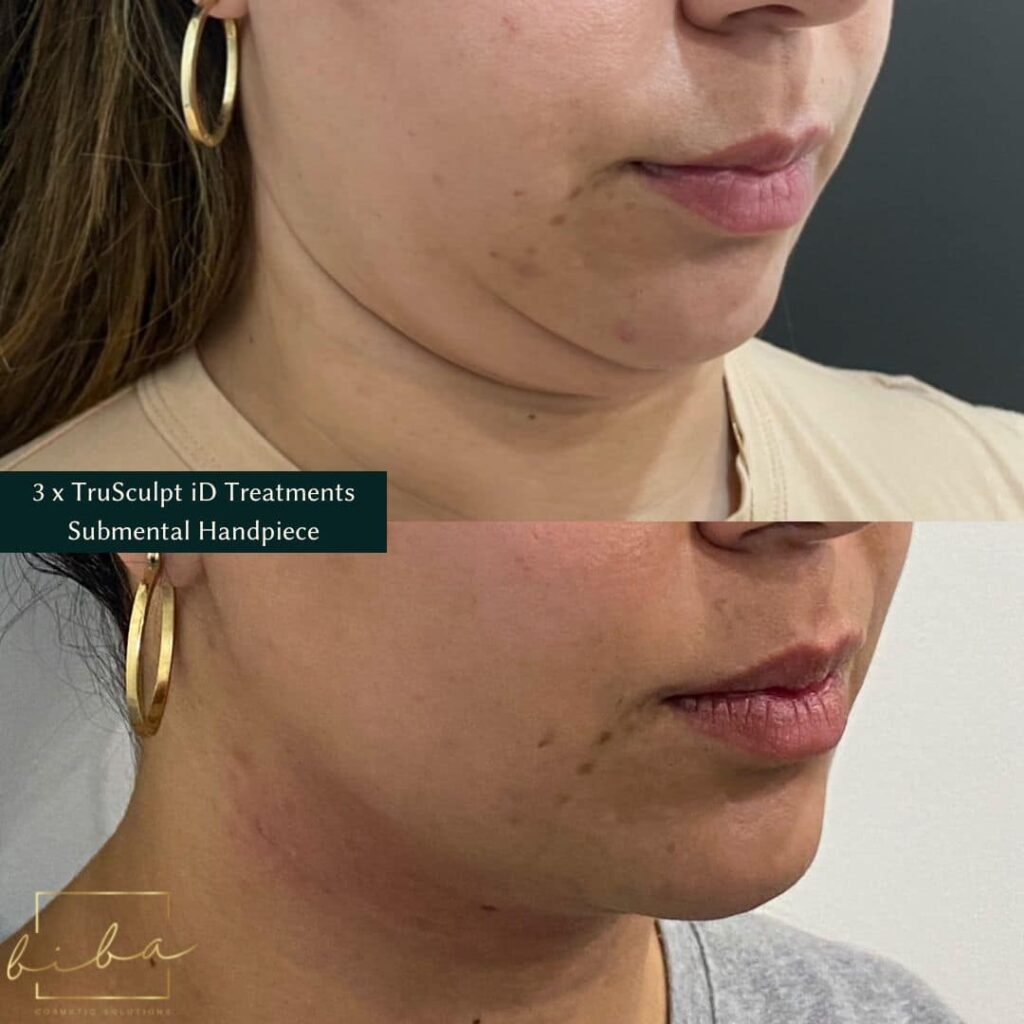 Before and after results of a TruSculpt iD treatment targeting the chin area, showing a noticeable reduction in fullness and improved contour.