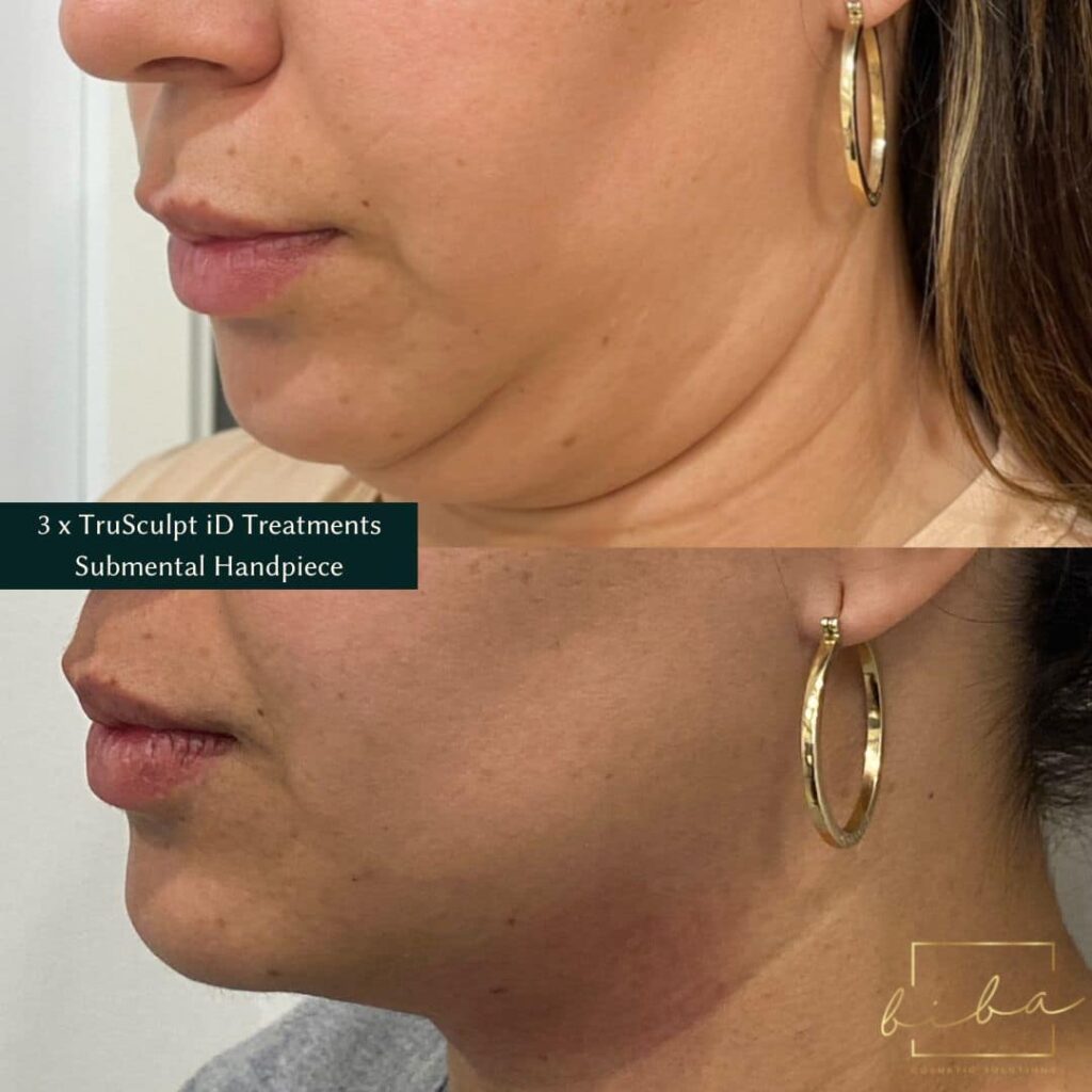 Before and after images showing reduced fullness under the chin following a TruSculpt iD body sculpting treatment.