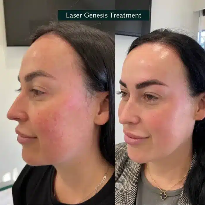 Before and after photos showing significant improvement in a client’s cheek and face after Excel V laser therapy.