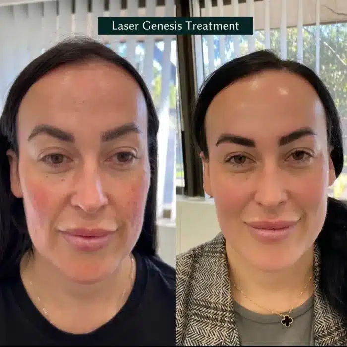 Before and after photos of a client’s face showing the results of Laser Genesis treatment, highlighting smoother skin and reduced redness.