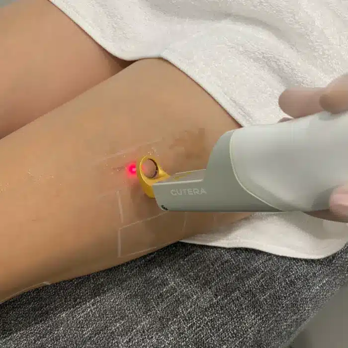 Excel V laser procedure being performed on a client’s leg by a skilled practitioner.