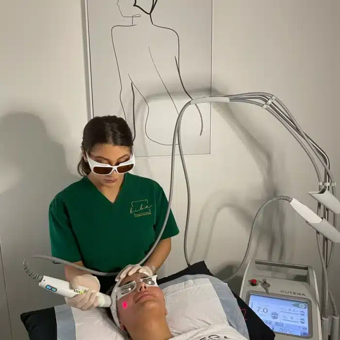 A client undergoing Excel V laser treatment at a professional skin care clinic, focused on targeted skin concerns.