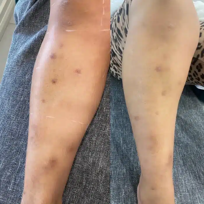 Before and after of a client’s leg showing improved skin appearance after laser therapy.