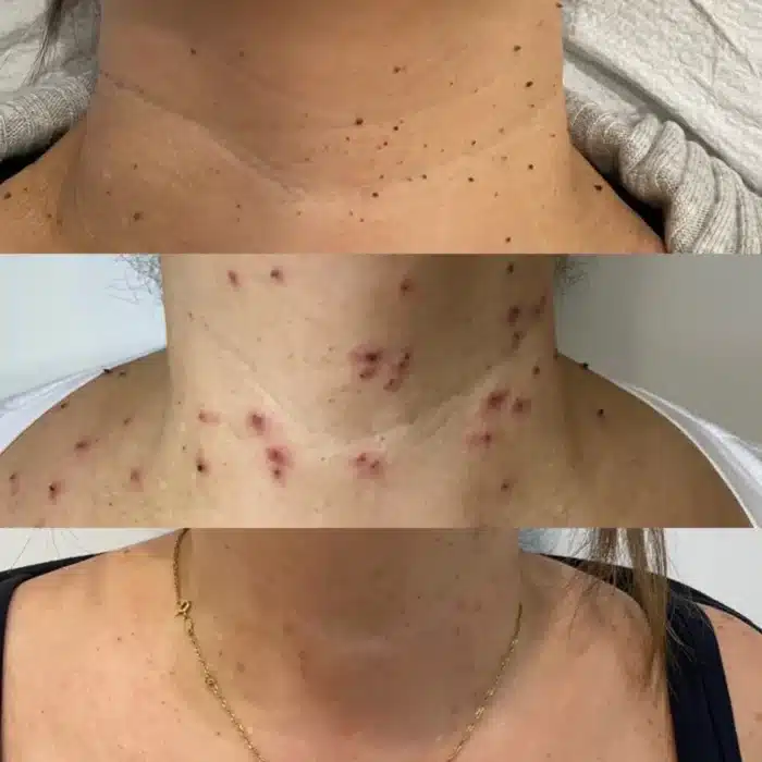 Side-by-side before and after images of a client’s neck, highlighting the removal of moles and freckles with Excel V laser therapy.