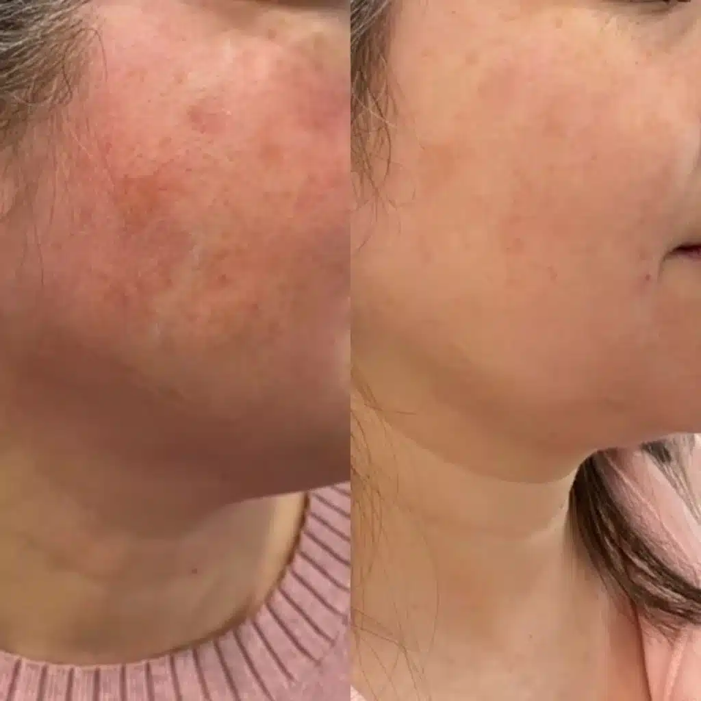 Before and after photos of a client’s cheek following Excel V laser treatment.