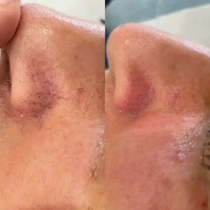 Close-up before and after images of a client’s nose treated with Excel V laser for clearer, smoother skin.