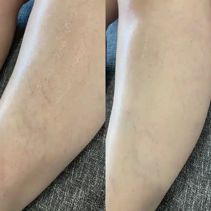 Before and after photos of a client’s leg after laser treatment, demonstrating improved skin tone and texture.