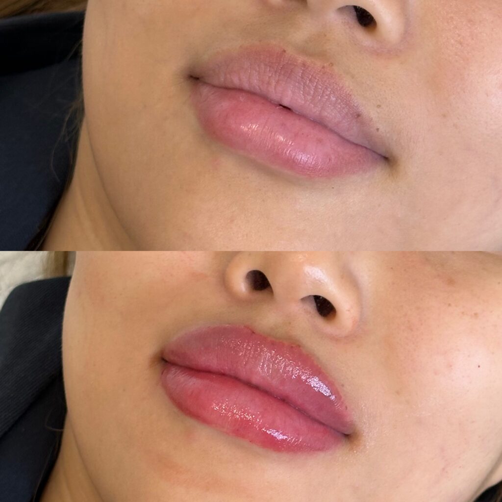 Before and after images showing enhanced lip volume and shape following a lip filler treatment.