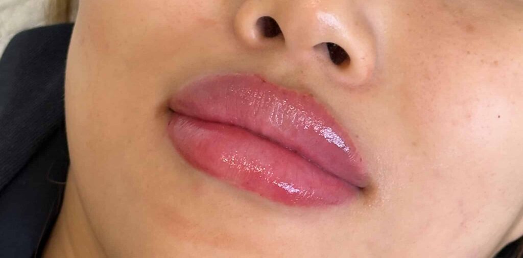 Before and after images following a lip filler treatment.