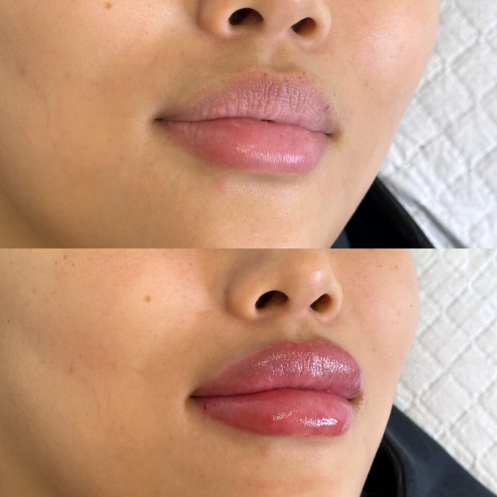 Visible transformation in lip fullness and definition displayed in before and after lip filler photos.