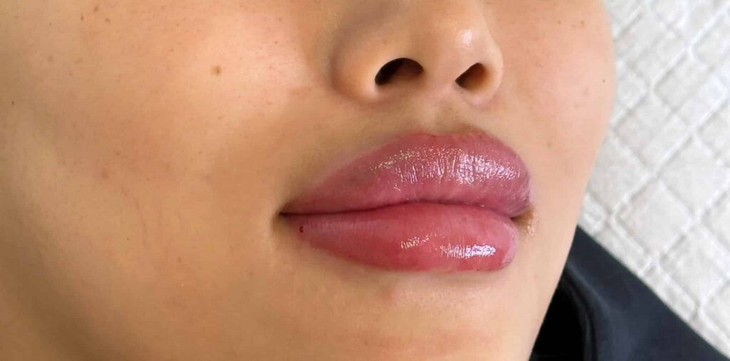 Before and after images following a lip volume treatment.