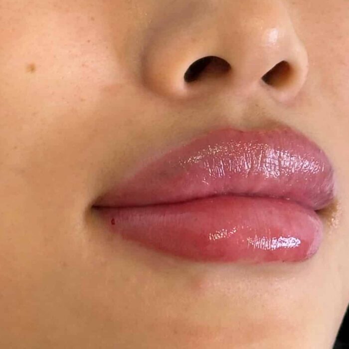 Before and after images following a lip volume treatment.