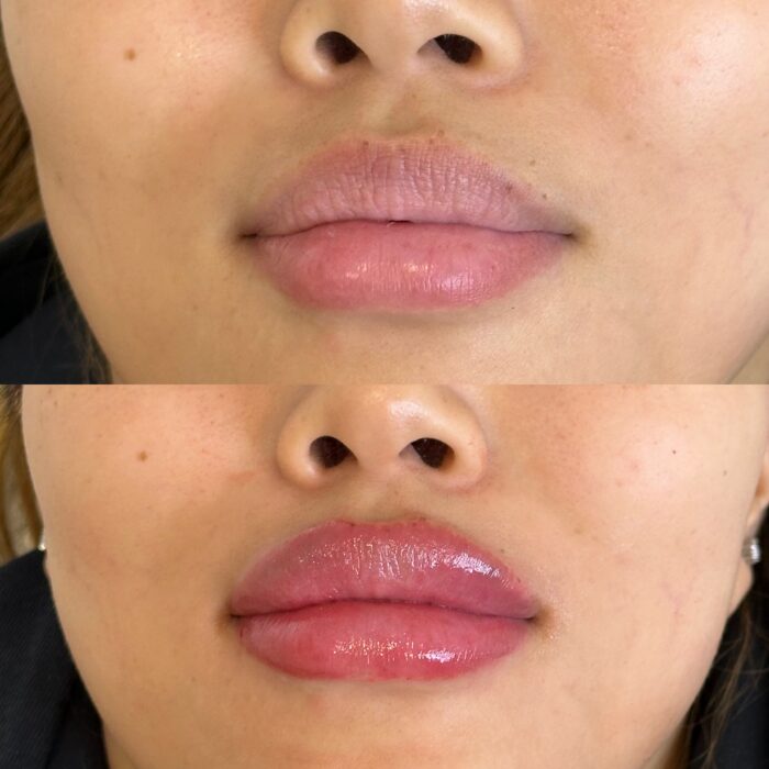 Comparison of a client’s lips before and after dermal filler treatment at a cosmetic clinic