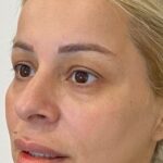 Before and after Morpheus8 on under-eye area