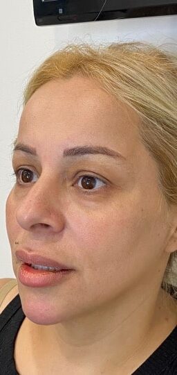 Before and after Morpheus8 on under-eye area