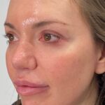 Before and after Morpheus8 on lower face and jowls