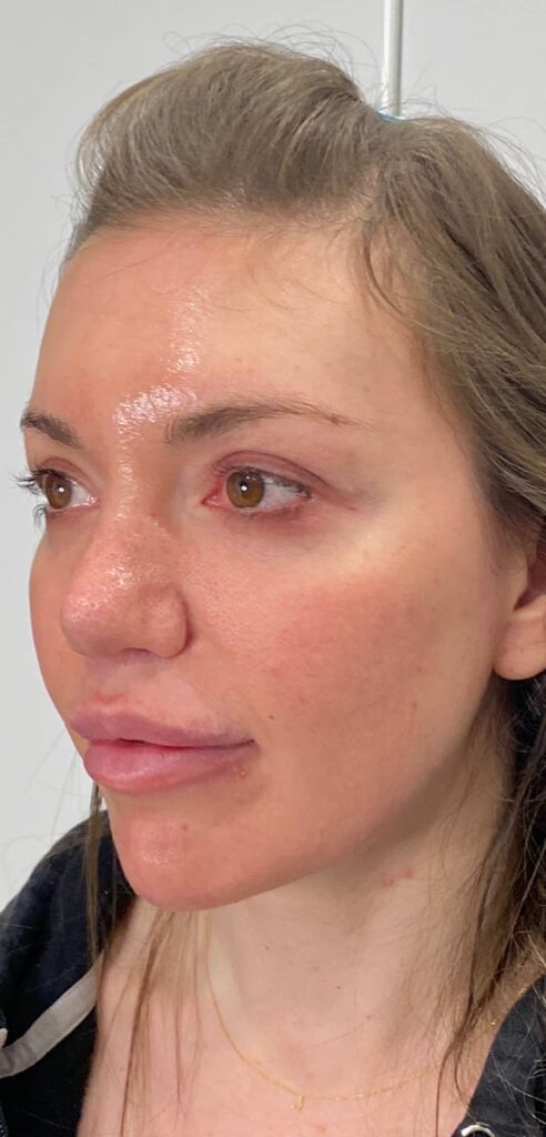 Before and after Morpheus8 on lower face and jowls