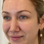 Clearer skin tone after Morpheus treatment at our skin clinic in Parramatta