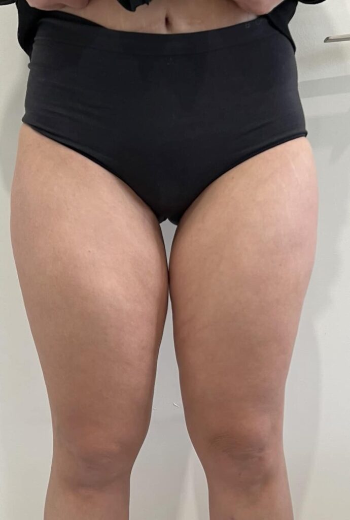 Cellulite reduction after Morpheus8 treatment