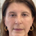 Before and after a Morpheus8 treatment at our skin clinic