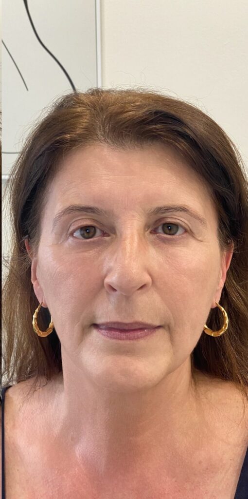 Before and after a Morpheus8 treatment at our skin clinic