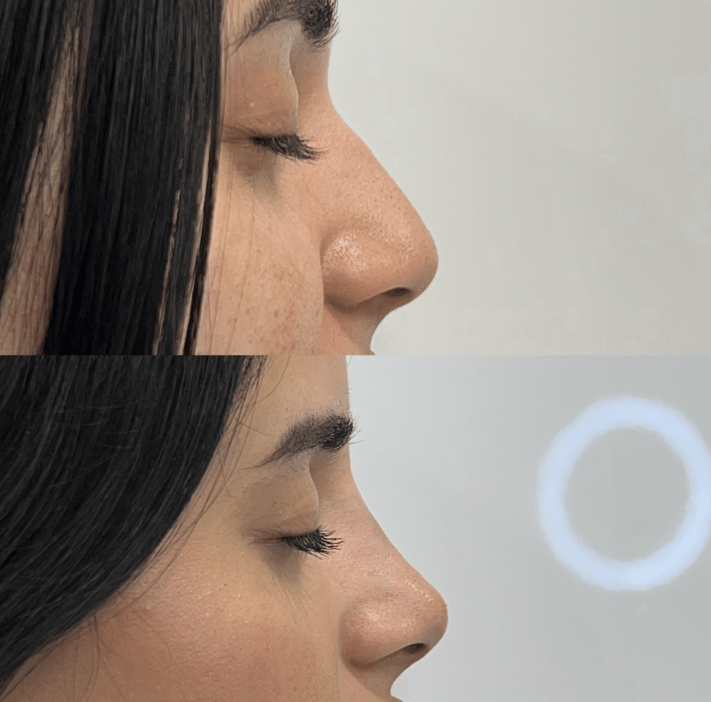 Before and after results of a non-surgical rhinoplasty treatment, highlighting subtle reshaping and improved nose contour.