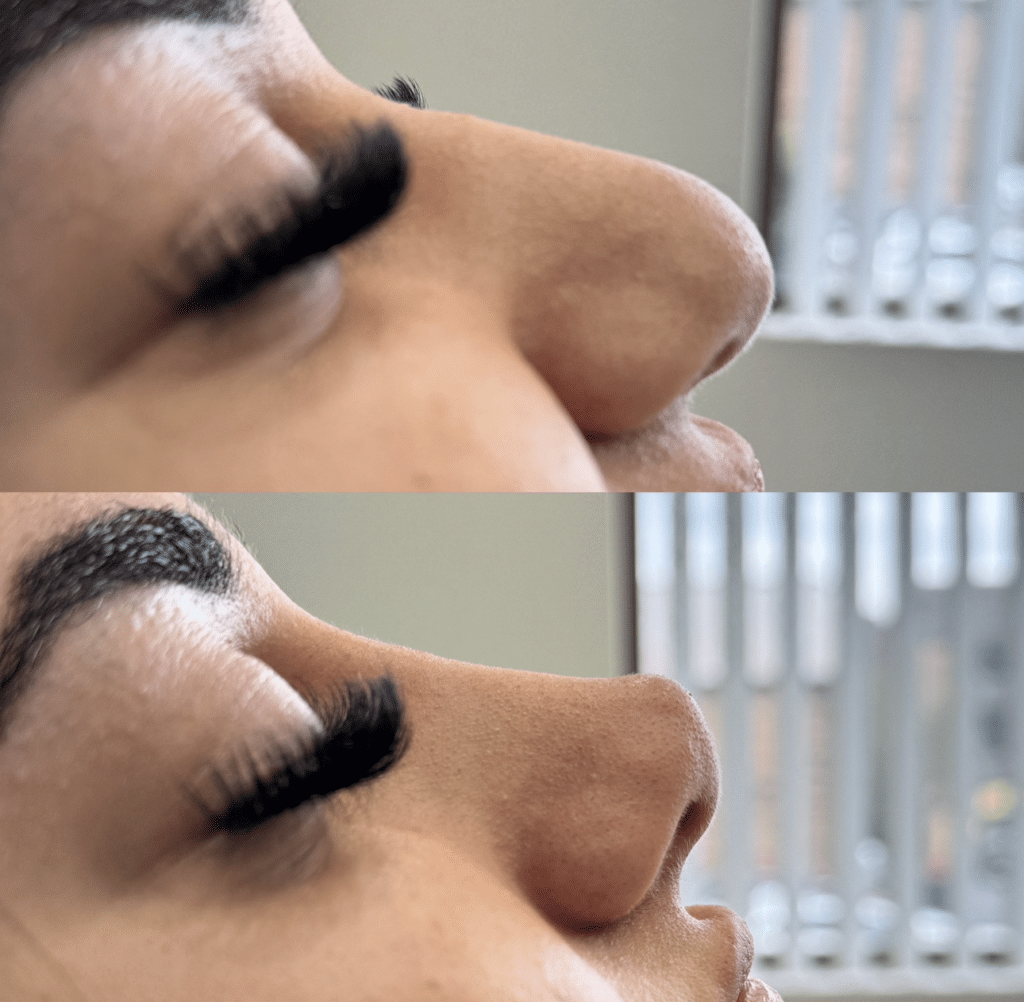 A comparison showing a client before and after a non-surgical rhinoplasty treatment at a cosmetic clinic.