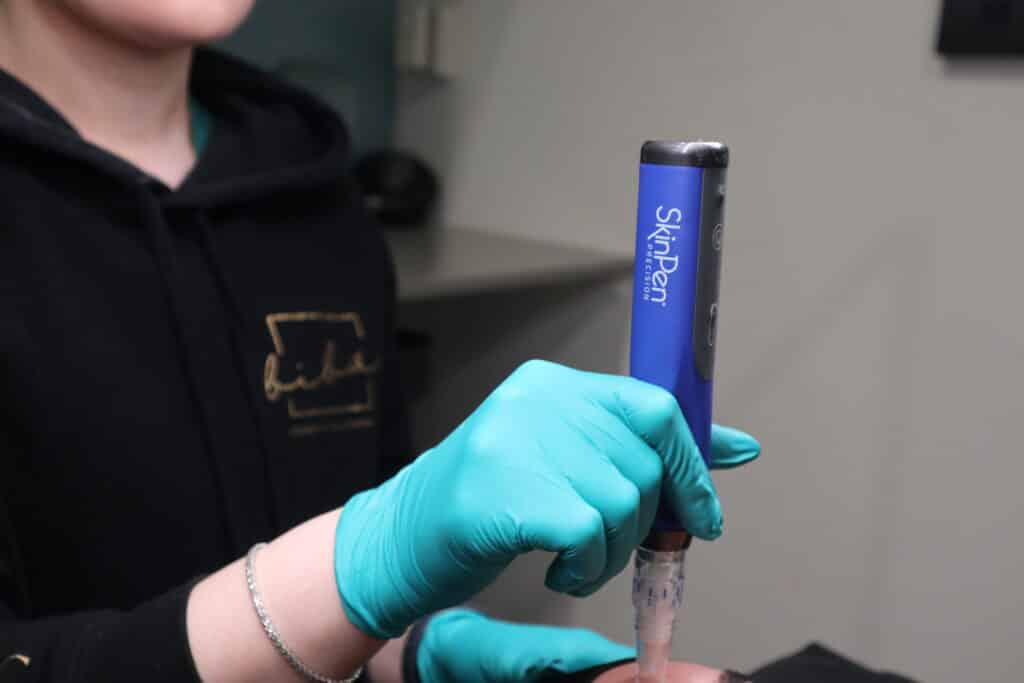A client undergoing skin needling therapy, as the therapist uses a specialised device to stimulate the skin.