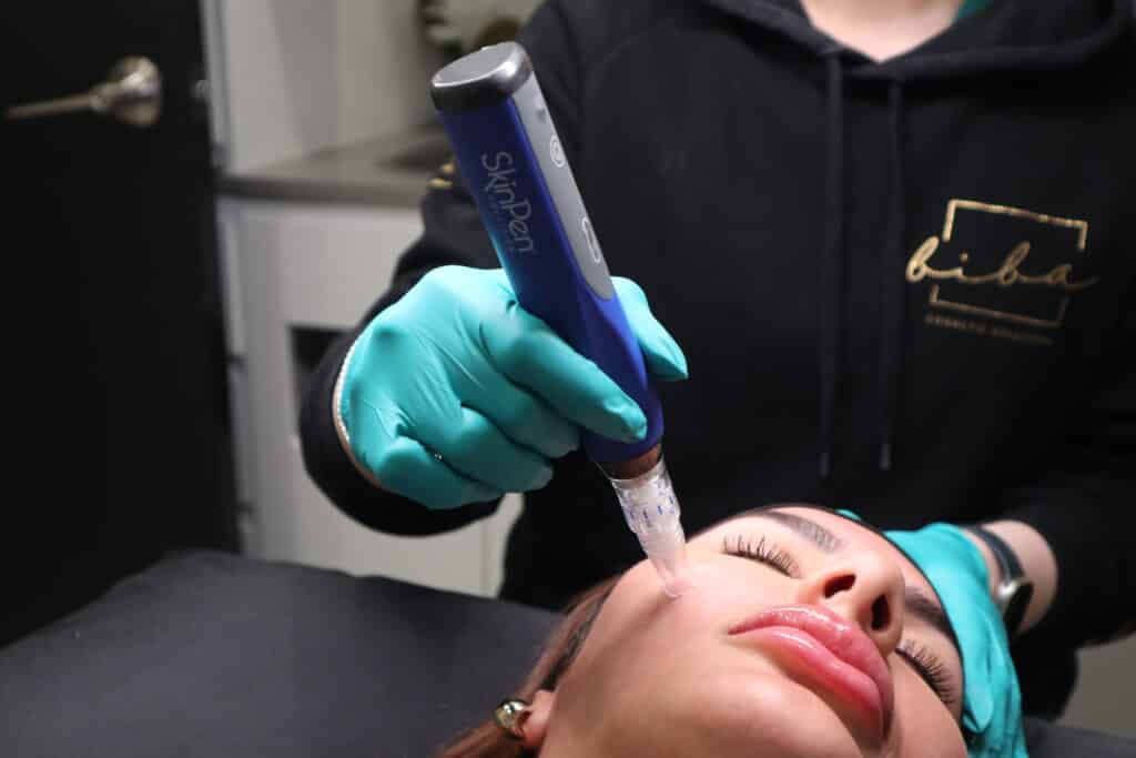 A close-up of a client receiving a skin tightening treatment through dermal needling by a professional practitioner.