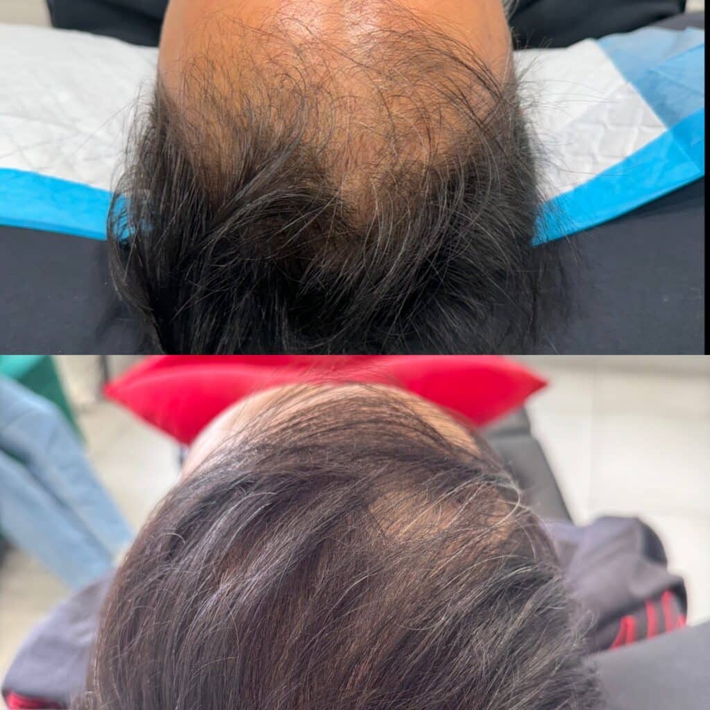 Before and after images showing visible improvement from a PRP hair growth treatment, highlighting increased thickness and coverage.