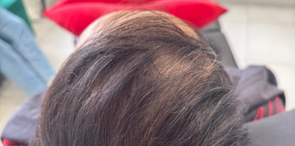 Before and after images showing visible improvement from a PRP hair growth treatment.