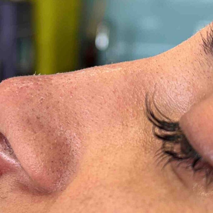 Post-procedure results of a non-surgical rhinoplasty treatment at a cosmetic clinic.