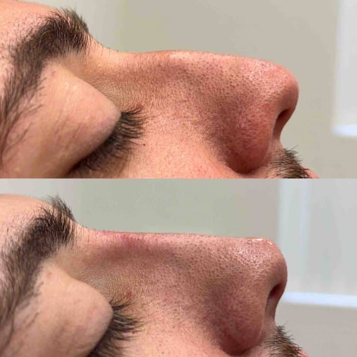 Before and after results of a non-surgical rhinoplasty procedure.