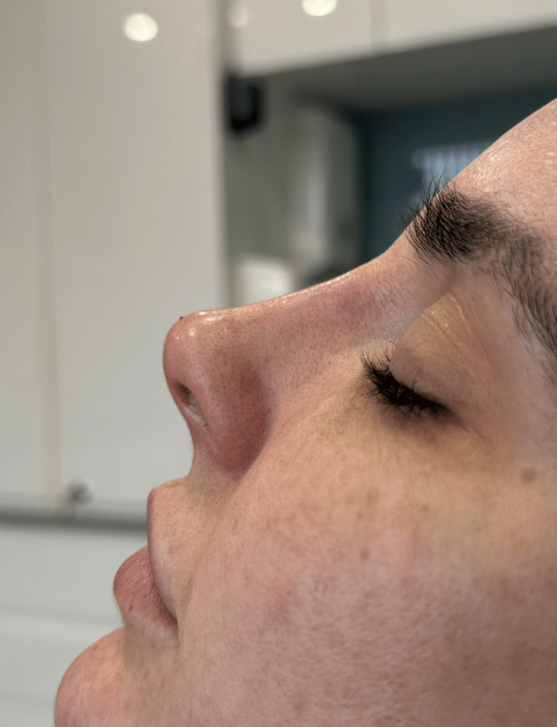 Close-up of a woman’s nose after a non surgical nose job, showing smooth contour and balanced shape.