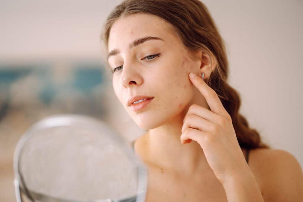 Young woman with acne on her face checking her spots in the mirror