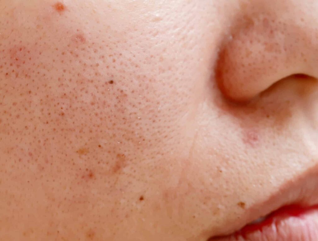 Close up of blackheads on a woman's cheek