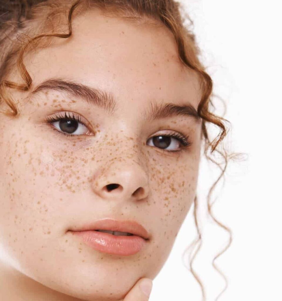 close up of a young woman with hyperpigmentation or freckles on her face
