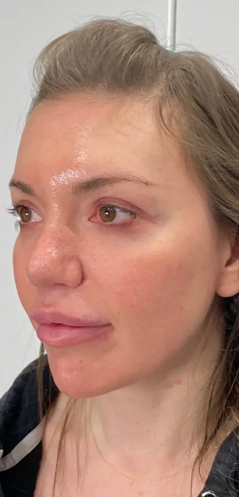 Before and after Morpheus8 on lower face and jowls