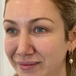 Clearer skin tone after Morpheus treatment at our skin clinic in Parramatta
