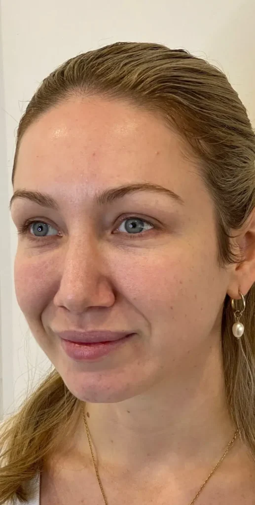 Clearer skin tone after Morpheus treatment at our skin clinic in Parramatta