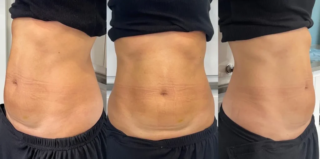 Before and after a Morpheus8 session at our Parramatta clinic
