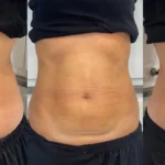 Before and after a Morpheus8 session at our Parramatta clinic