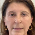 Before and after a Morpheus8 treatment at our skin clinic