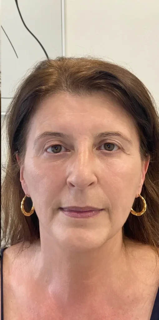 Before and after a Morpheus8 treatment at our skin clinic