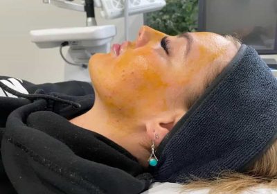 Customer undergoing chemical peels treatment at our cosmetic clinic in parramatta